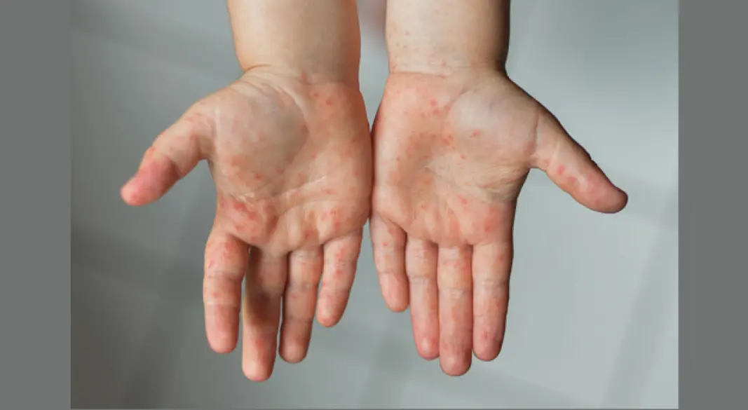 সাম্প্রতিক সময়ে দেশের বিভিন্ন জেলায় শিশুদের মধ্যে হাম ছড়িয়ে পড়ার খবর অভিভাবকদের মধ্যে উদ্বেগ বাড়িয়ে তুলেছে। ছবি : সংগৃহীত